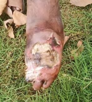 Close-up of Lakshmi’s severely infected foot before treatment at Mother Teresa’s Nirmala Hospital in New Delhi. Doctors feared amputation, but faith and prayer led to a miracle recovery.