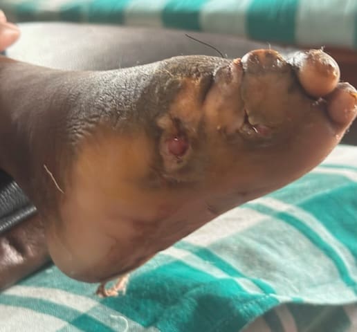 Lakshmi’s foot shows early stages of healing after weeks of treatment at Mother Teresa’s Nirmala Hospital in New Delhi, part of the Lakshmi leprosy miracle.
